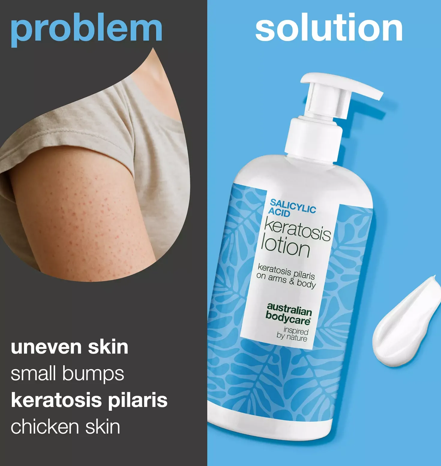 Australian Bodycare Salicylic Acid Keratosis Lotion 500 ml