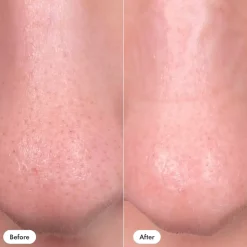 Hero Nose Patch