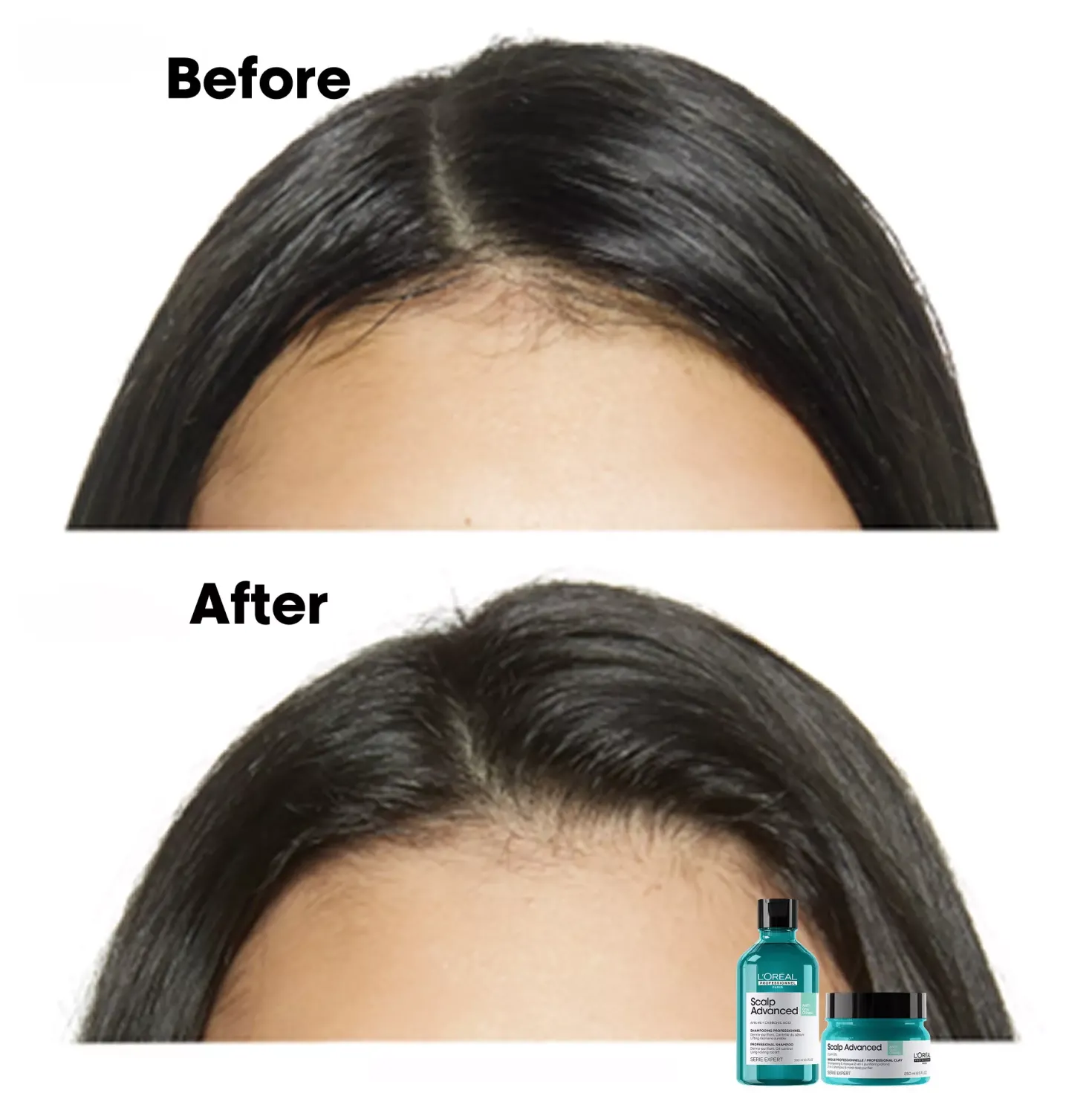 L'Oréal ProfessionnelScalp Advanced Professional Shampoo For Oily Scalp 300 ml