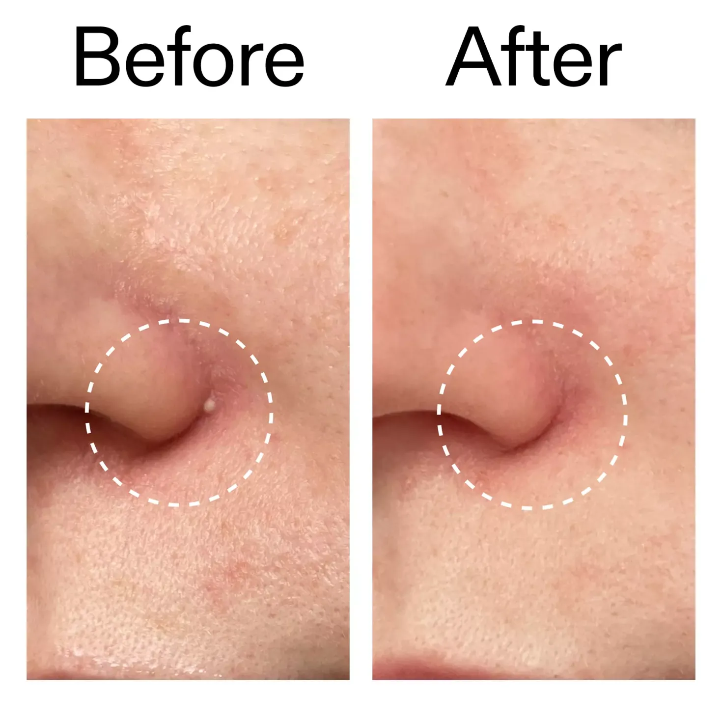 The Inkey List Hydrocolloid Invisible Pimple Patches 22 stk